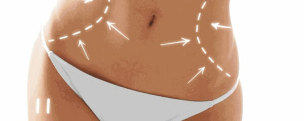 abdominoplasie